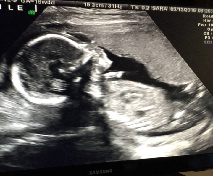 超聲波顯示佳苗第二胎是個男孩。(圖：力克臉書)