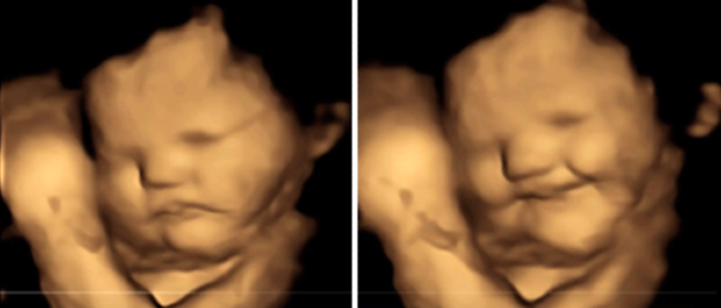 嬰兒休息的樣子［左］，吃完胡蘿白後皺著眉頭［右］。（NBC News《Today Show》擷圖） 