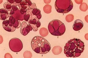 狼瘡細胞(圖片:37c醫學網) <br/>